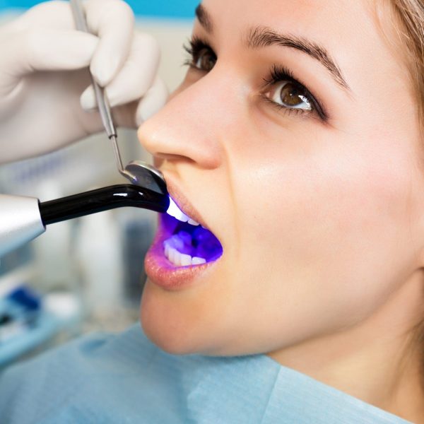 The reception was at the female dentist. Doctor examines the oral cavity on tooth decay. Caries protection. Tooth decay treatment. Dentist working with dental polymerization lamp in oral cavity.