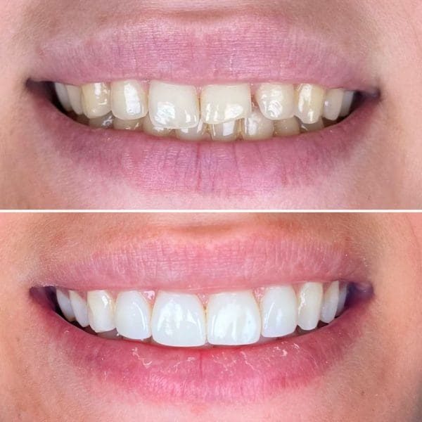 Composite Bonding After 5 Years - Tips to Extend Lifespan