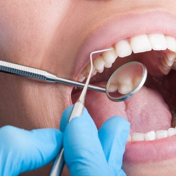 The Important of Regular Dental Cleanings